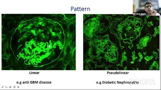 Dr Alok Sharma  Interpretation of Immunofluorescence and Electron Microscopy in Renal Biopsies [upl. by Cranston]