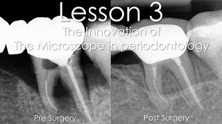 MicroDentistry MicroscopicPeriodontology 歯周病 歯周病治療 顕微鏡歯科 Lesson 3 Colombia [upl. by Ev301]