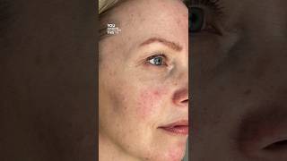 ROSACEA skin care TREATMENT ‼ [upl. by Jilleen]