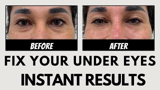 Refresh Your Under Eyes Instantly with this Procedure [upl. by Eatnahs867]