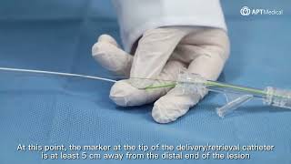 Demonstration of EmboCatcher™ Embolic Protection Device [upl. by Enneire525]