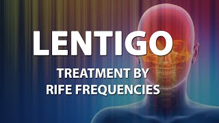 Lentigo Skin  RIFE Frequencies Treatment  Energy amp Quantum Medicine with Bioresonance [upl. by Howzell887]