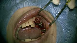 Straumann NC RN WN place in posterior mandible 4 [upl. by Lamraj]