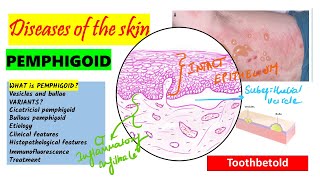 Pemphigoid Causes pathogenesis Types Histopathology Treatment  Pemphigus vs Pemphigoid [upl. by Harelda]