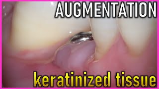 AUGMENTATION of keratinized tissue on IMPLANT [upl. by Adiaz]