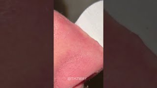 First time peeling whitehead got tearing relaxingtriggers skincare satisfying [upl. by Inat11]