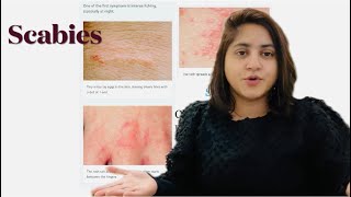 Scabies  Diagnosis  Symptoms  DOS and DONTS  Treatment  Permethrin 5 cream  Scabies MITES [upl. by Narok720]