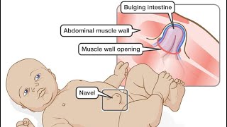 Umbilical hernia in newborn babies hernia newmom newbornbaby newborn [upl. by Runkle]