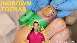 Effortless Ingrown Toenail Removal  PainFree Treatment In Minutes  Miss Foot Fixer [upl. by Hairim]