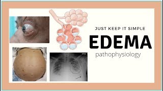 Edema Pathophysiology  Pulmonary edema Ascites physiology basics Med Madness [upl. by Hofstetter]