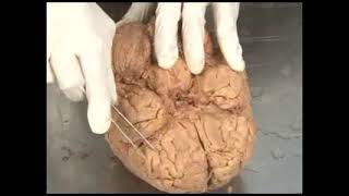 🧠🔥OPEN BRAIN  SULCUS amp GYRUS 3 brain anatomy learning medical india usa uk europe israel [upl. by Utter]