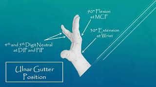 Ulnar Gutter Splint [upl. by Ashelman]