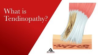 What is Tendinopathy [upl. by Bowes]