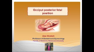 Occiput posterior fetal position [upl. by Haikan450]