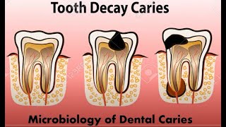 Histopathology of dental caries Functions of saliva [upl. by Swithbart]