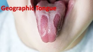 Geographic Tongue  Home Remedies for Geographic Tongue [upl. by Treboh128]