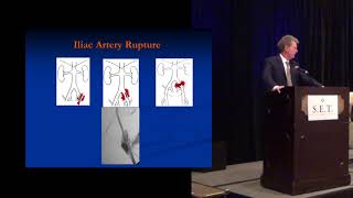 Endovascular Treatment of IliofemoralSFA Occlusion [upl. by Tnomad]