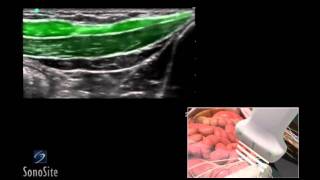 How To Ilioinguinal and Iliohypogastric Regional Nerve Block 3D Video [upl. by Anson]