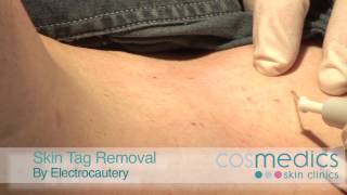 Skin Tag Removal by Laser  Surgery [upl. by Asillam]