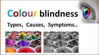 Colour blindness  Types Causes Symptoms Treatment [upl. by Auhel]