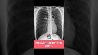 chest xray radiographie thoracique doctor [upl. by Samau302]