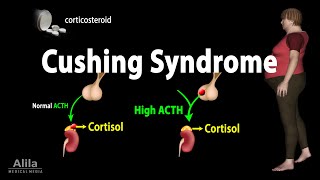 Cushing Syndrome Animation [upl. by Airehc208]