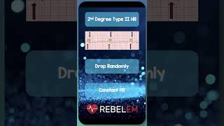 2nd Degree Type II Heart Block REBELEM ECG EKG HeartBlocks [upl. by Silvestro]