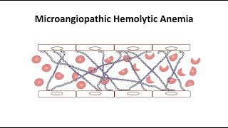 Microangiopathic Hemolytic Anemia [upl. by Desta]