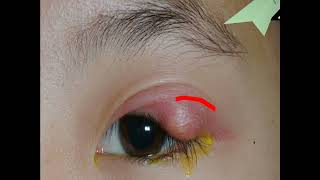 STYE  Disease of an Eyelid [upl. by Annoled]