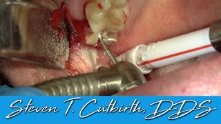 Surgical Extraction of Maxillary 2nd Molar  Dental Minute with Steven T Cutbirth DDS [upl. by Cordey]