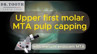 upper right first molar cavity preparation and MTA pulp capping 상악 제1대구치 우식제거 및 MTA pulp capping [upl. by Aicert]