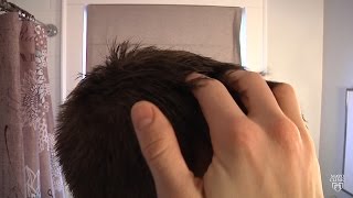 Mayo Clinic Minute Tips for dealing with dandruff [upl. by Chiarra]