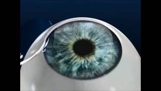 iDesign LASIK  at MaloneyShamie Vision Institute [upl. by Nakada]