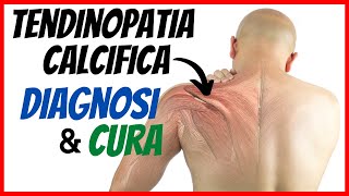 🔴 TENDINOPATIA CALCIFICA di SPALLA  Come si diagnostica e si cura [upl. by Venu]