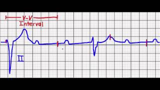 Cardiac Pacing Failure to CaptureFailure to Sense [upl. by Alves]