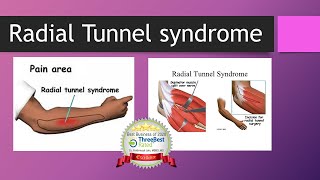 Radial Tunnel Syndrome [upl. by Edijabab705]