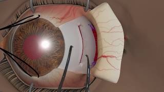 Strabismus surgery Recession [upl. by Kristof]