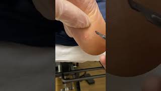 Expert Australian Podiatrist Removes Painful Corns with Precision [upl. by Warthman]