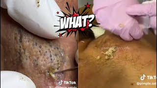 Ultimate ASMR Pimple Popping Extravaganza  Relaxing Blackhead Removal amp Skin Care [upl. by Inait]