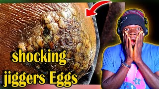 Jiggers shocking jiggers Eggs [upl. by Kihtrak]