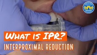 Interproximal Reduction IPR on Teeth for Braces and Invisalign [upl. by Maon]