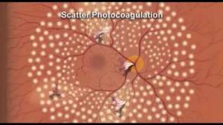 Pan Retinal Photocoagulation Diabetic Retinopathy [upl. by Urana]