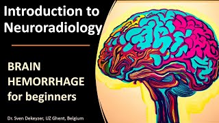 Imaging of Spontaneous Brain Hemorrhage the basics [upl. by Ard]