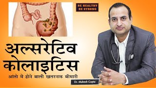 Ulcerative Colitis  अल्सरेटिव कोलाइटिसआंतो की गंभीर बीमारी  Dr Mahesh Gupta [upl. by Delano]