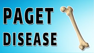 Imaging Paget disease of bone [upl. by Piper656]