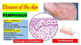 Pemphigus Vulgaris Pathogenesis clinical features oral manifestations  Pemphigus Variants PART 1 [upl. by Enelia294]