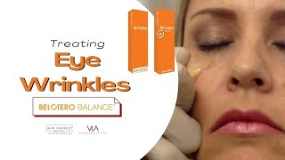 Eye Wrinkle Removal with Belotero Filler  Skin Perfect Los Angeles Area [upl. by Ednutey]