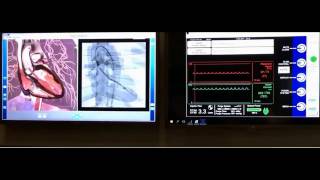 Impella Dual Screen Positioning Groove [upl. by Rehpitsirhc]