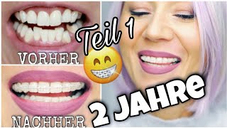 2 JAHRE FESTE ZAHNSPANGE  UPDATE😮 QampA Zahnspange Erwachsene Keramik Brackets WithKat [upl. by Eidaj]