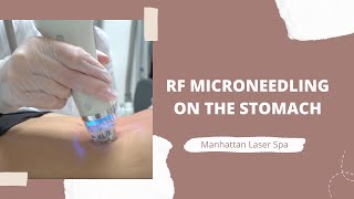 How to TIGHTEN loose skin on your TUMMY  MICRONEEDLING BEFORE AND AFTER on the Stomach [upl. by Bev]